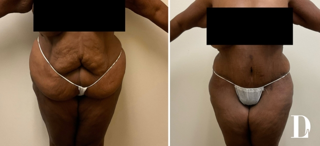 Tummy Tuck before and after - before