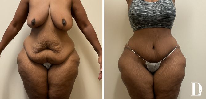 Tummy Tuck and Liposuction before and after - before