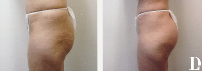 Butt Implant Surgery before and after - before