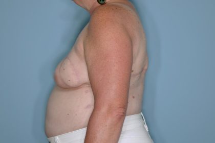 Breast Reconstruction before and after - after