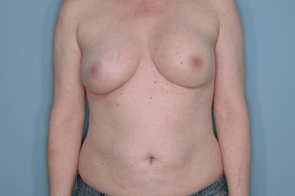 Breast Reconstruction before and after - after