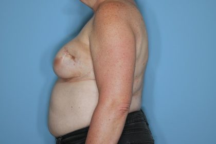 Breast Reconstruction before and after - after