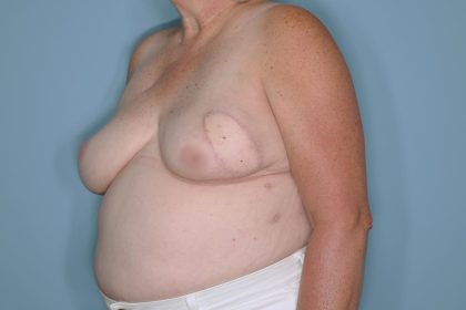 Breast Reconstruction before and after - before