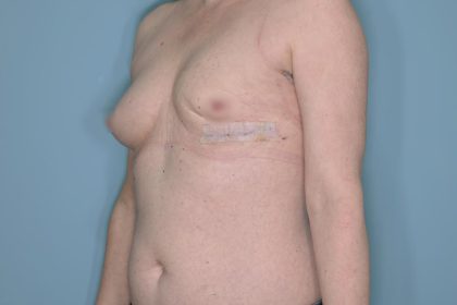 Breast Reconstruction before and after - before