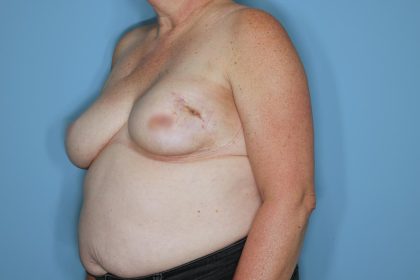 Breast Reconstruction before and after - before