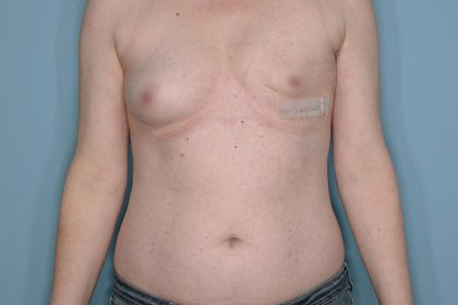 Breast Reconstruction before and after - before