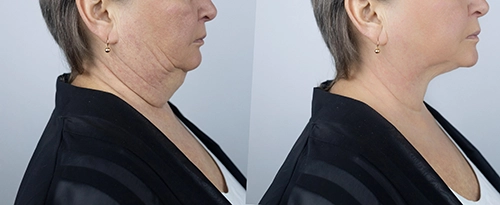 Liposuction before and after - after