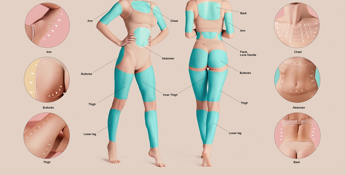 Liposuction before and after - after