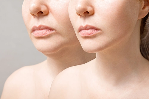 Liposuction before and after - before