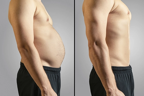 Liposuction before and after - before