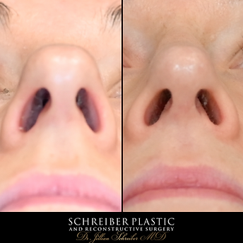 Closed Preservation Rhinoplasty before and after - after