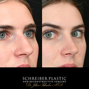 Rhinoplasty, Chin Implant, Lower Blepharoplasty, Fat Grafting before and after - after