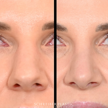 Open structural rhinoplasty before and after - after