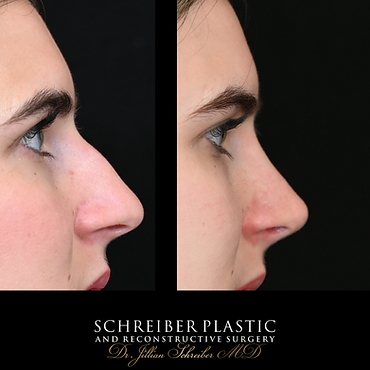 Rhinoplasty, Chin Implant, Lower Blepharoplasty, Fat Grafting before and after - before