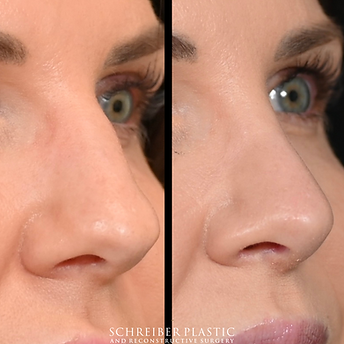 Open structural rhinoplasty before and after - before