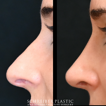 Closed Preservation Rhinoplasty before and after - before