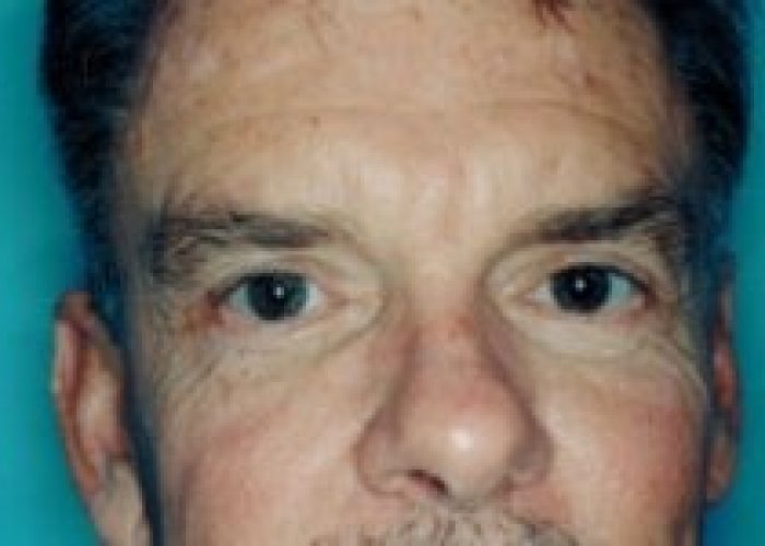 Eyelid Surgery after — Dr. Ronald Edelson