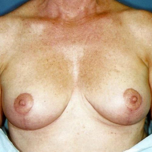 Breast Lift before and after - after