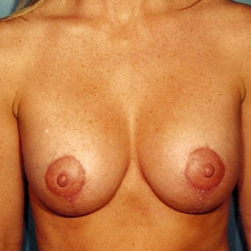 Breast Lift before and after - after