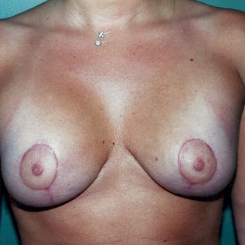 Breast Lift before and after - after