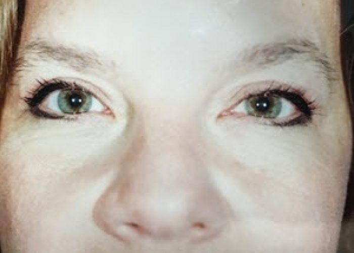 Rhinoplasty before and after - after