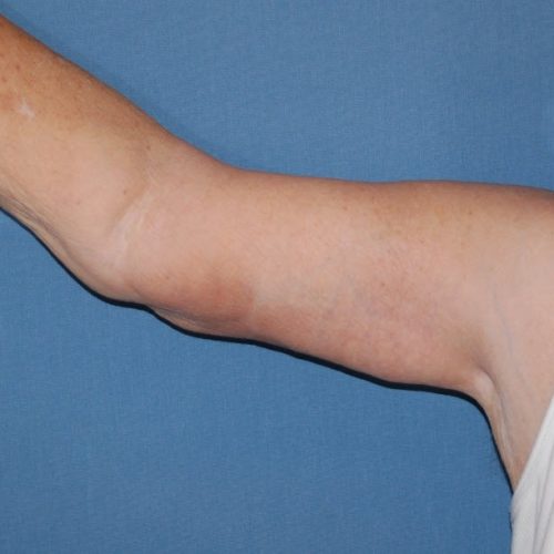 Arm Lift before and after - after