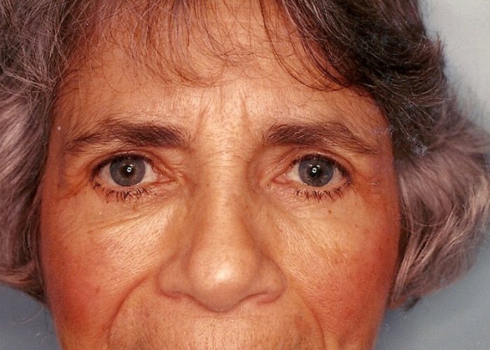Eyelid Surgery after — Dr. Ronald Edelson