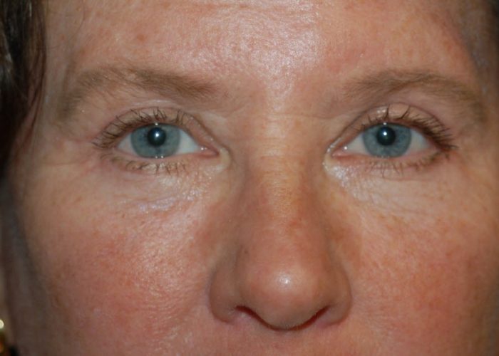Eyelid Surgery after — Dr. Ronald Edelson