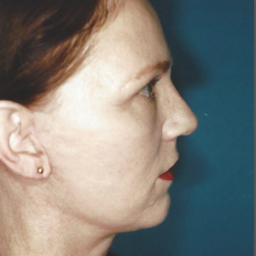  before and after - after