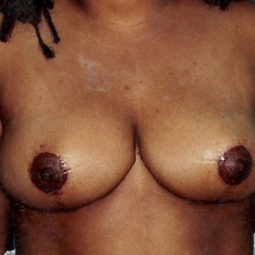 Breast Reduction before and after - after