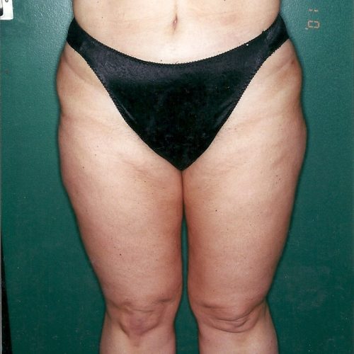 Liposuction before and after - after