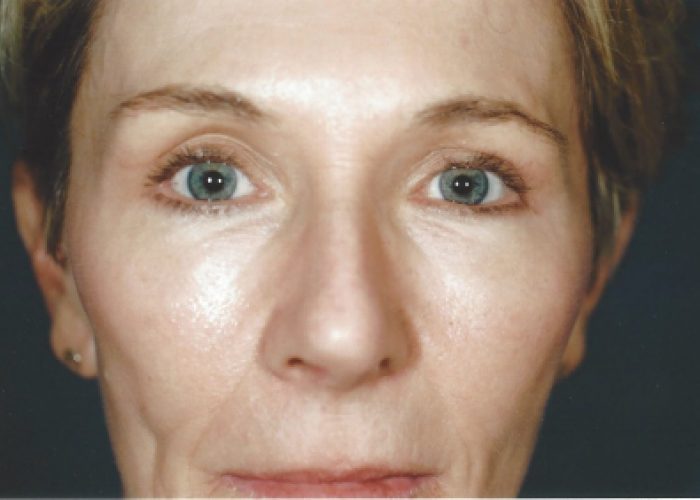 Eyelid Surgery after — Dr. Ronald Edelson