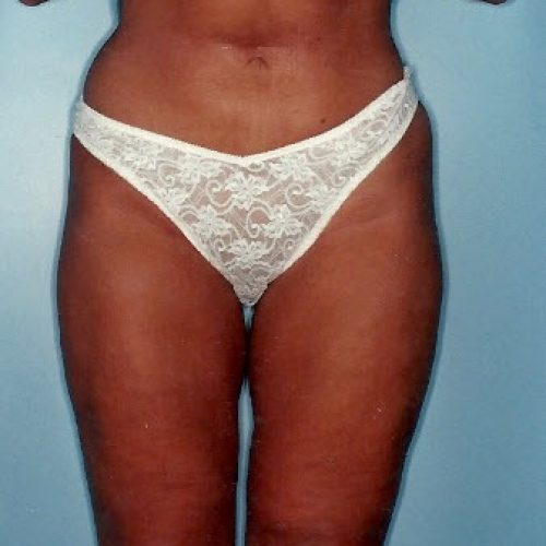 Liposuction before and after - after