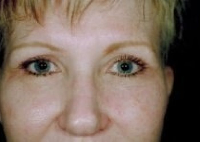 Eyelid Surgery after — Dr. Ronald Edelson