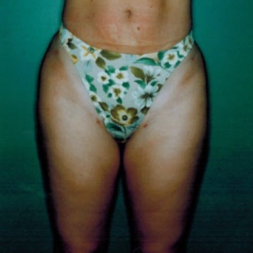 Liposuction before and after - after