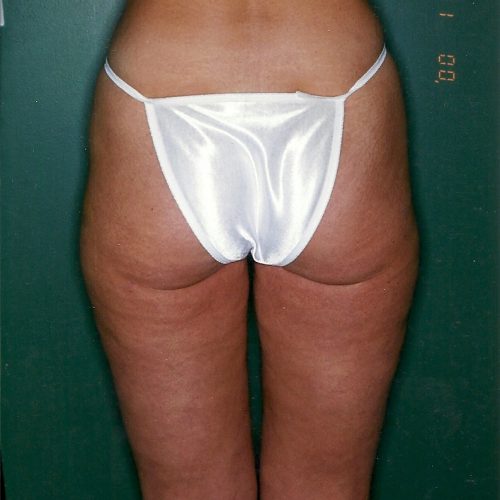 Liposuction before and after - after