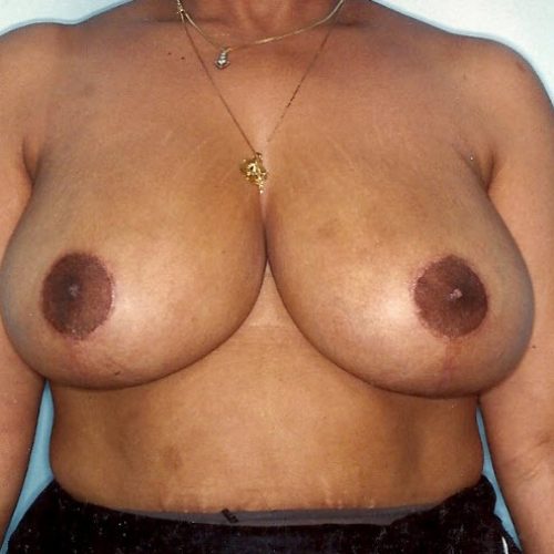 Breast Reduction before and after - after