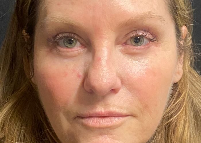 Eyelid Surgery after — Dr. Ronald Edelson