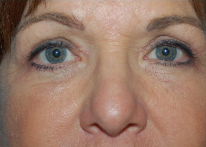 Eyelid Surgery after — Dr. Ronald Edelson
