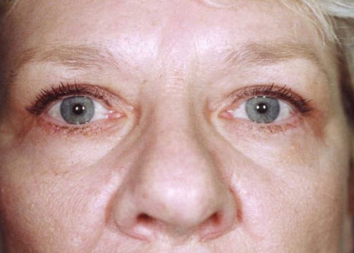 Eyelid Surgery after — Dr. Ronald Edelson