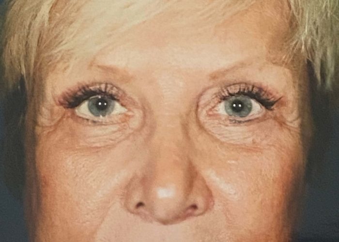 Eyelid Surgery after — Dr. Ronald Edelson