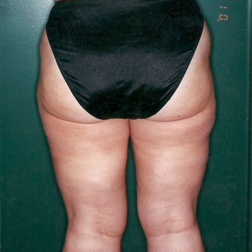 Liposuction before and after - after
