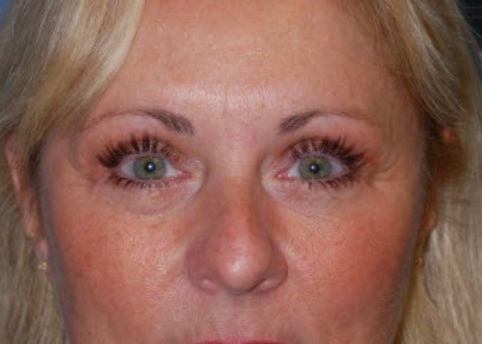 Eyelid Surgery after — Dr. Ronald Edelson
