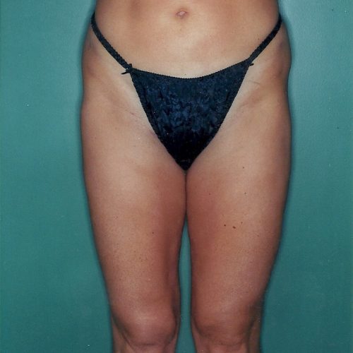 Liposuction before and after - after