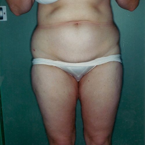 Liposuction before and after - after