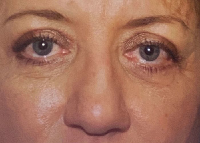 Eyelid Surgery after — Dr. Ronald Edelson