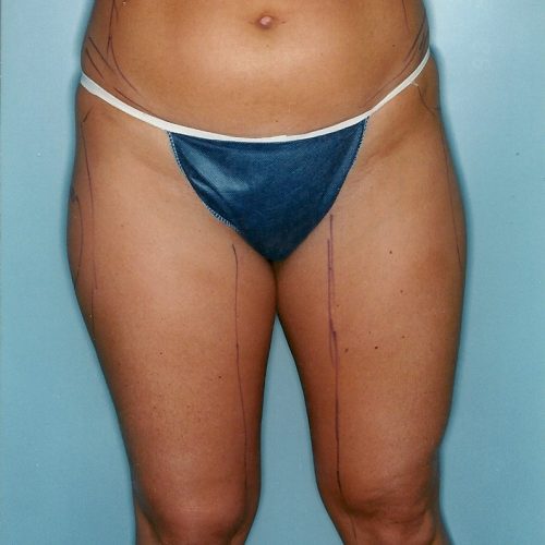 Liposuction before and after - before