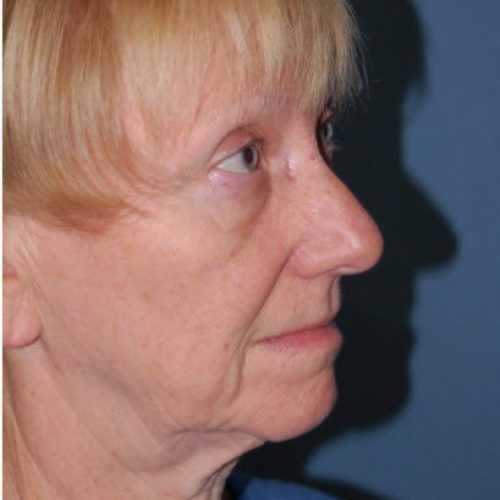  before and after - before
