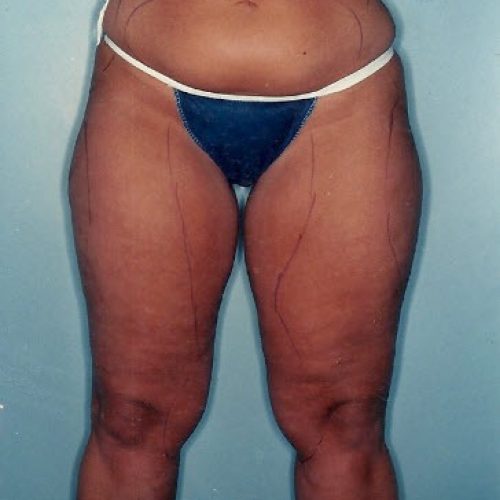 Liposuction before and after - before
