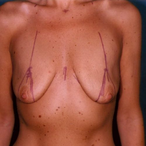 Breast Lift before and after - before